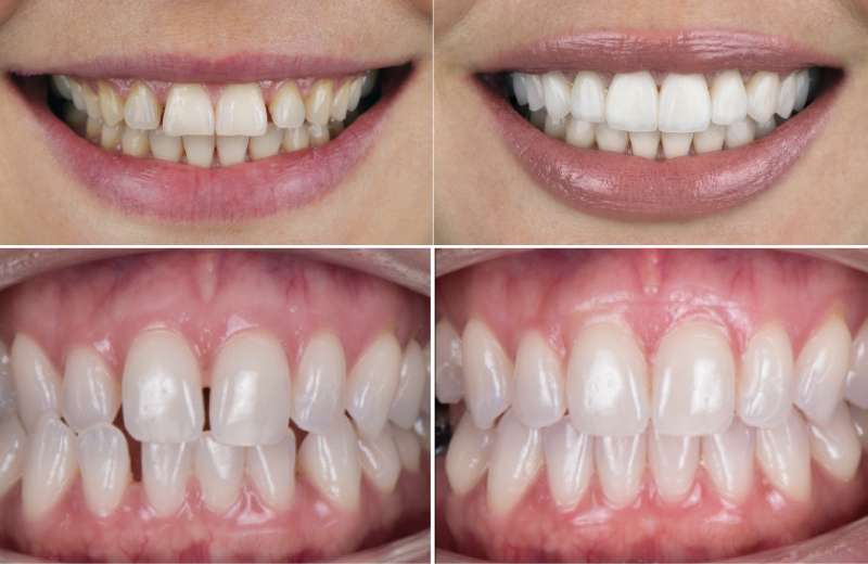 Before and after SureSmile aligners at Contemporary Dental Concepts