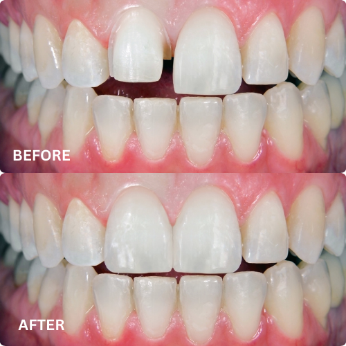 Close-up smile with porcelain veneers