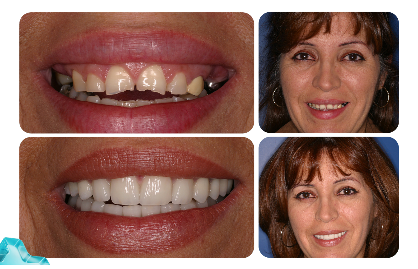 Patient smile transformation example 3
