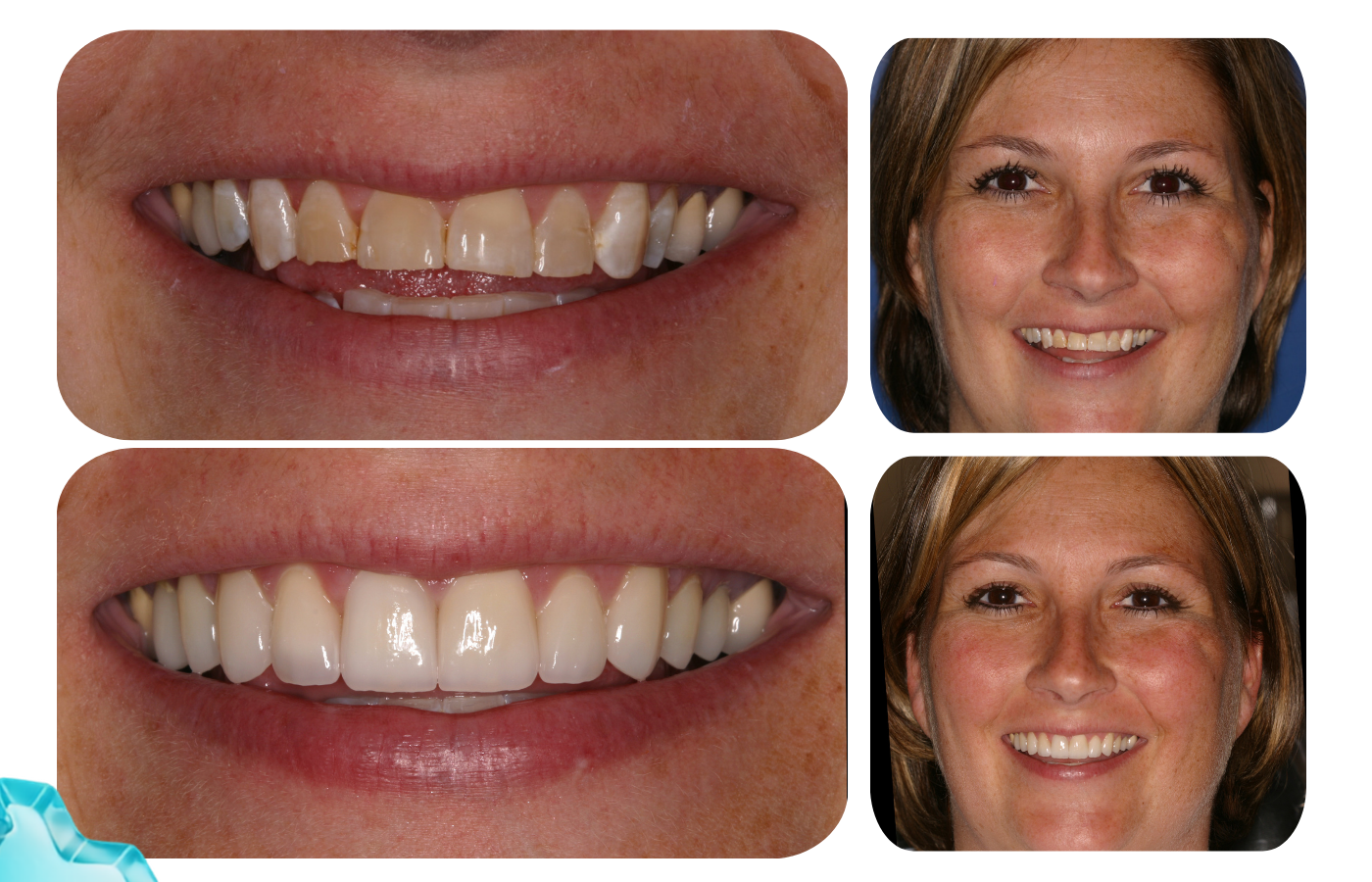 Patient smile transformation example 4