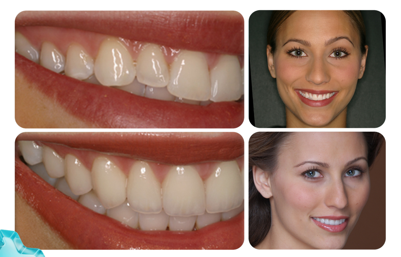 Placeholder for an approved dental implant patient story