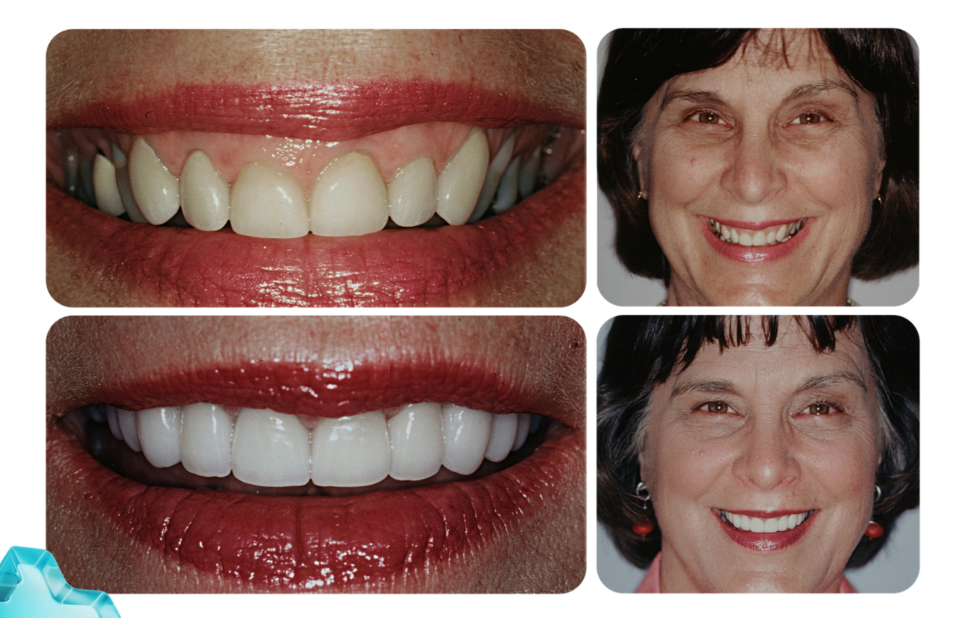 Patient smile transformation example 1