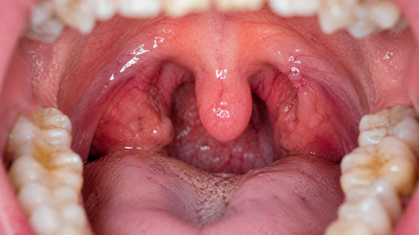 Open mouth clinical view highlighting an enlarged uvula and collapsing soft palate tissue causing restricted airways, treated at Contemporary Dental Concepts in Tempe, AZ.