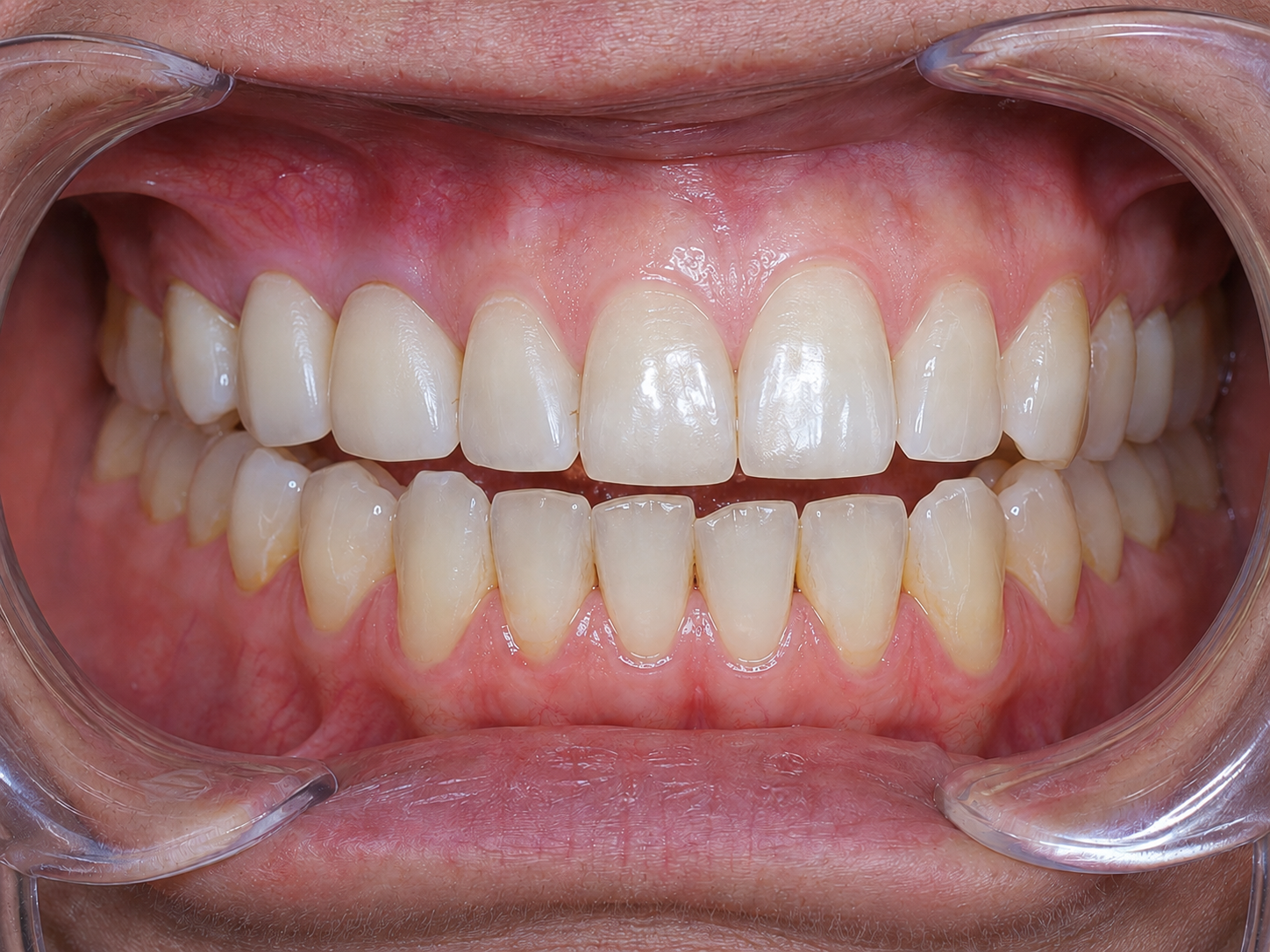 After dental implants at Contemporary Dental Concepts in Tempe, AZ.