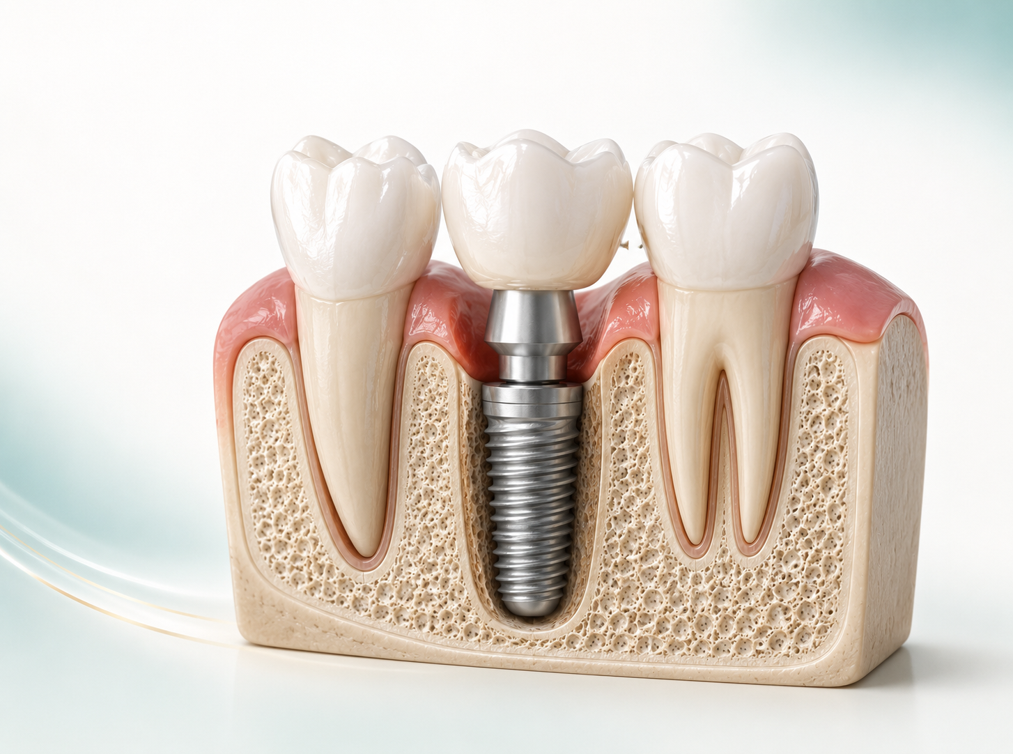 Illustration of a single-tooth dental implant and crown