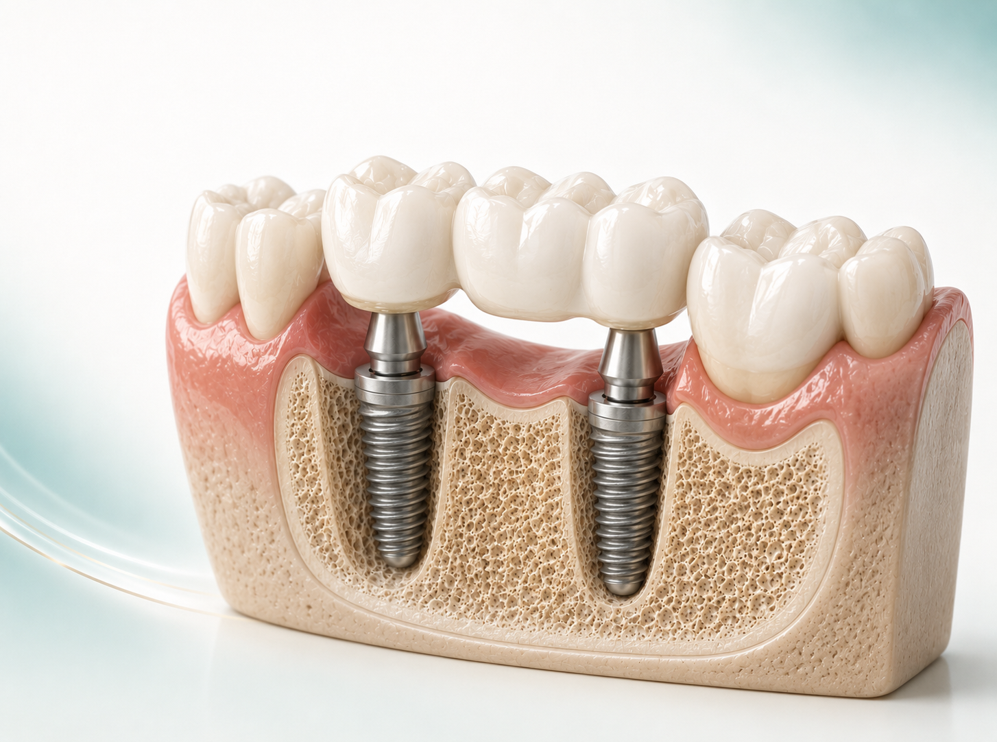 Illustration of an implant-supported dental bridge