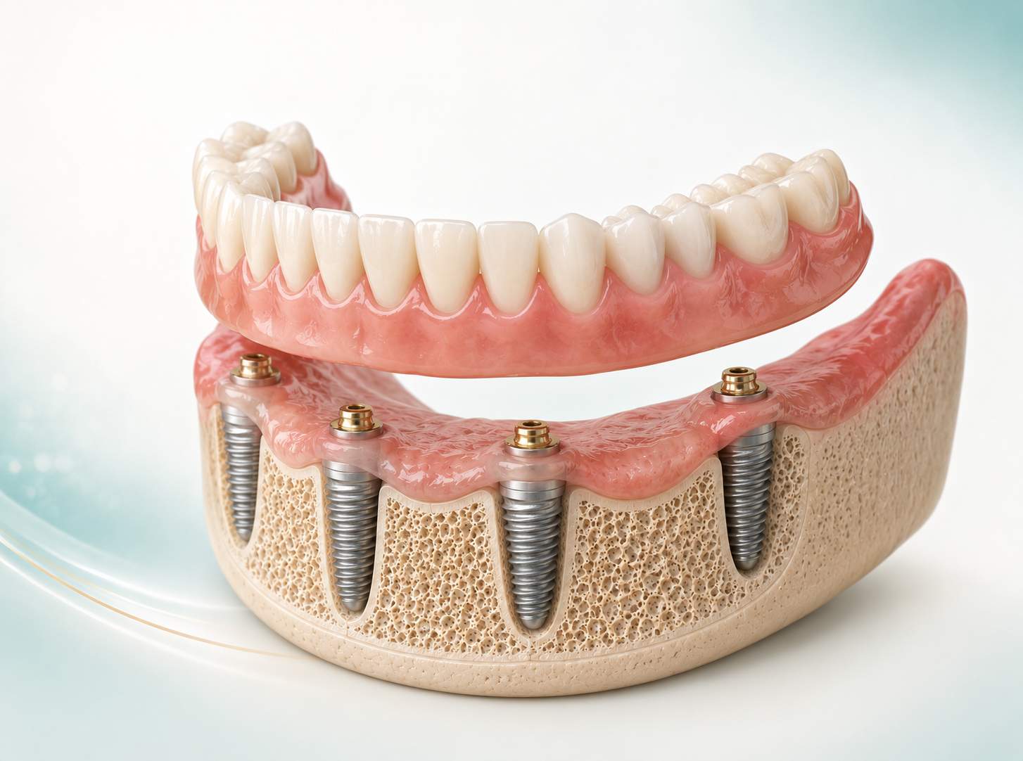 Illustration of an implant-supported denture