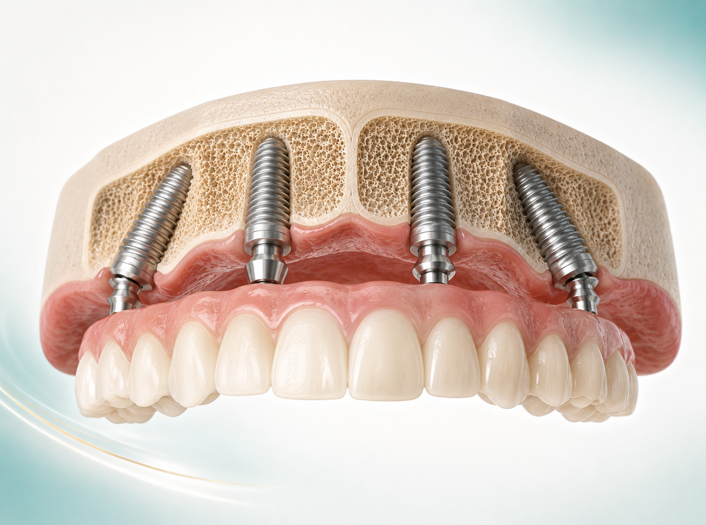 Illustration of a full-arch implant-supported restoration