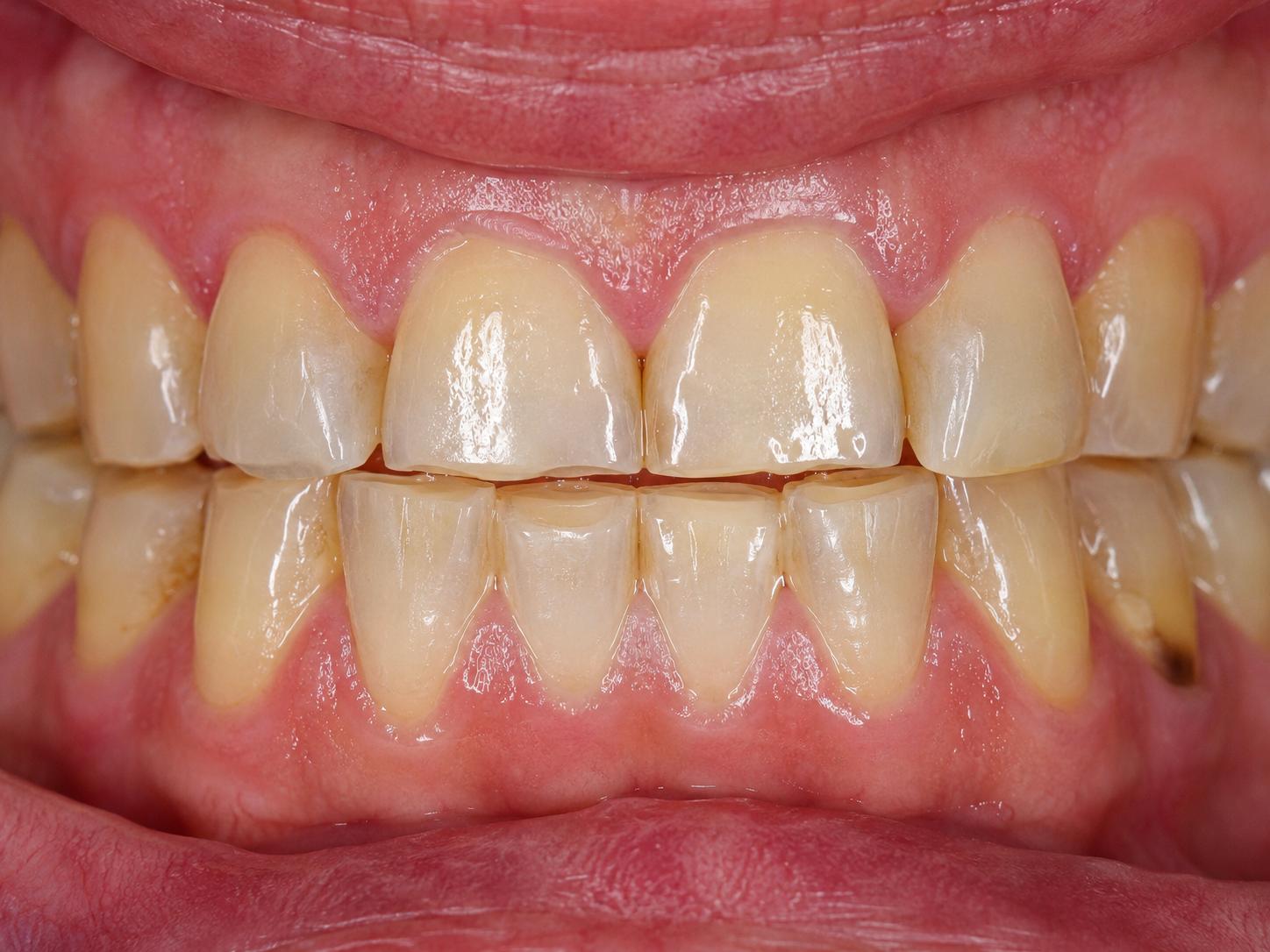 Illustrative placeholder for tooth wear from clenching or grinding