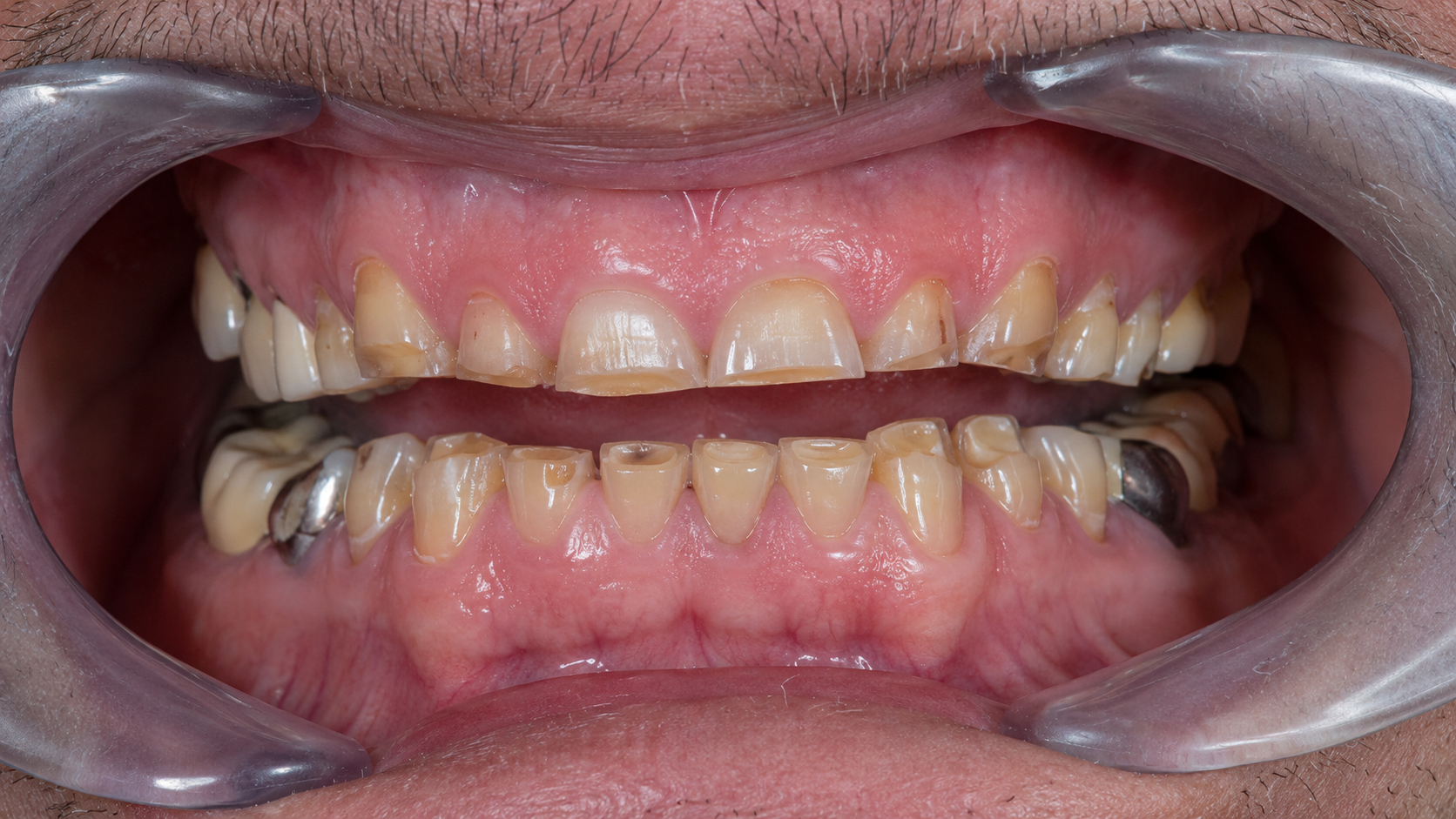Clinical view of generalized severe tooth wear with shortened and flattened teeth before restorative evaluation.