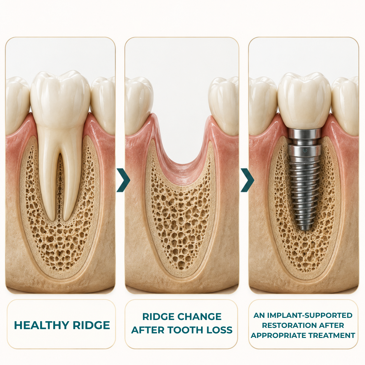 Illustration showing jawbone changes after tooth loss and an implant-supported replacement tooth